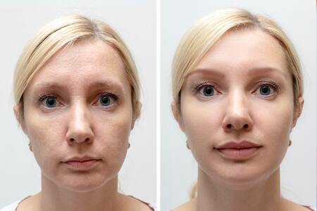 before after result