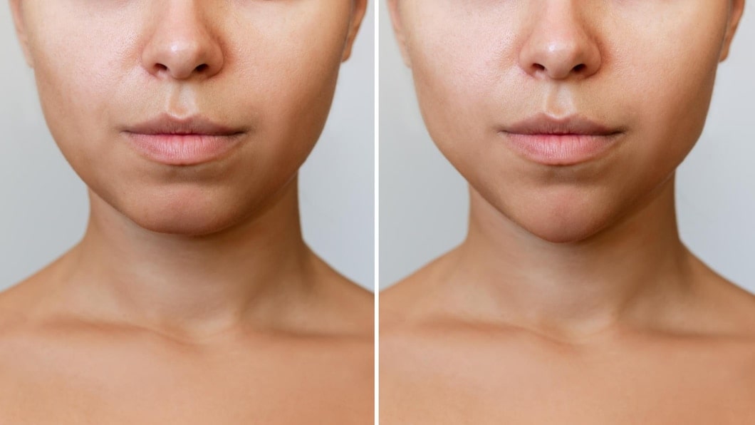 Lower face rejuvenation with Botox – natural smooth finish, Manhattan