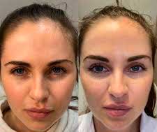 Subtle Botox lift for brows – natural rejuvenation by Dr. Fuzayloff