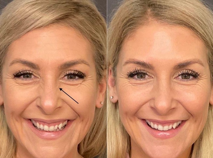 Before and after Botox for bunny lines on nose – Midtown Med Spa NYC