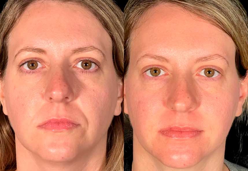 Before and after filler for nasolabial folds – Midtown Med Spa NYC