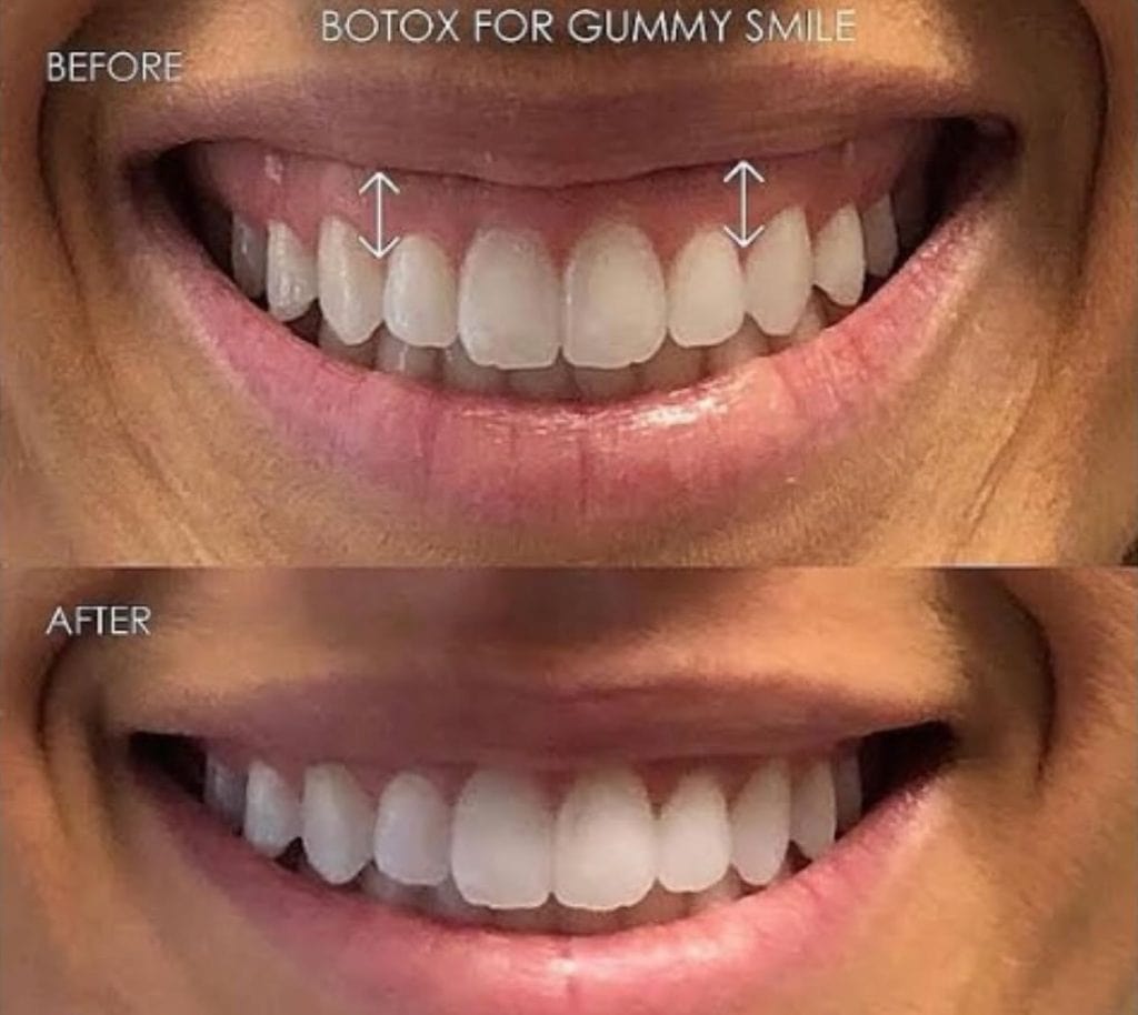 Before and after Botox for gummy smile correction – Midtown Med Spa NYC